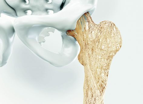 Osteoporose – rechtzeitig behandeln und Folgeschäden vermeiden