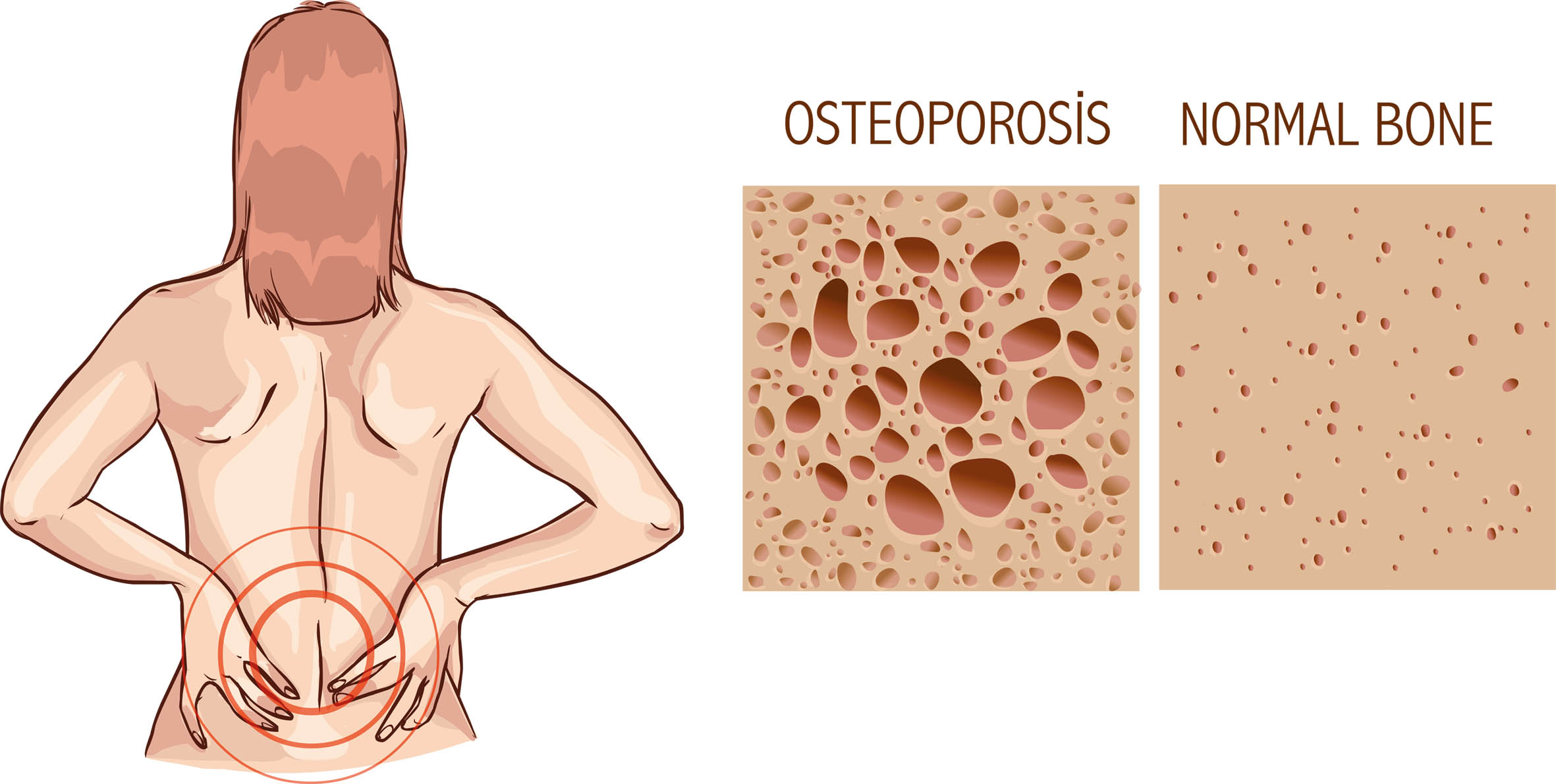 Der „Knochenräuber“ Osteoporose